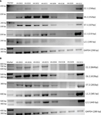 Long-read sequencing of oropharyngeal squamous cell carcinoma tumors reveal diverse patterns of high-risk Human Papillomavirus integration